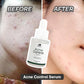 Acne Control Serum